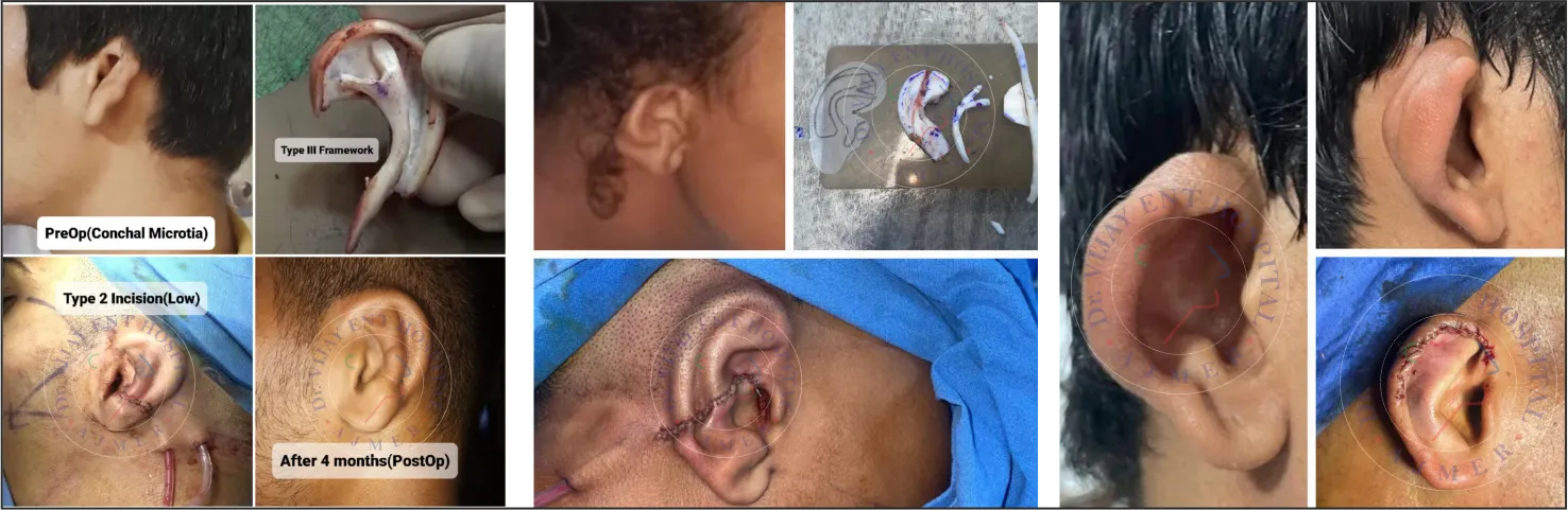 Ear Reconstruction Surgery Pre and Post